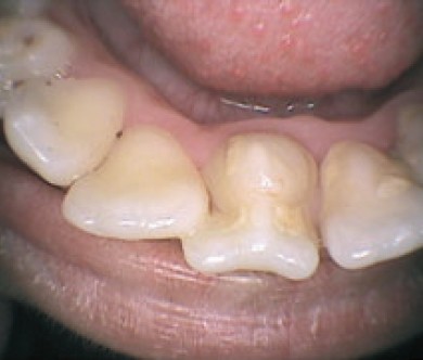 cúspide de carabelli