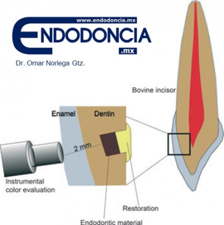 Pigmentación dental inducida por materiales endodónticos (MTA,AH26,Roth 801, Endofill, Tubliseal, ZOE, Cavizol, AH Plus y Endorez)