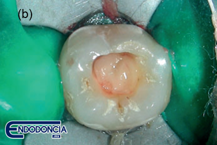 Fibrina rica en plaquetas (FRP) como medicamento en pulpotomía de un molar permanente con pulpitis irreversible: Reporte de un caso