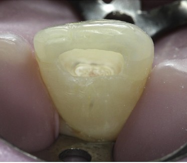 Pulpotomia / Recubrimiento Pulpar Directo con MTA en un Organo Dentario Permanente